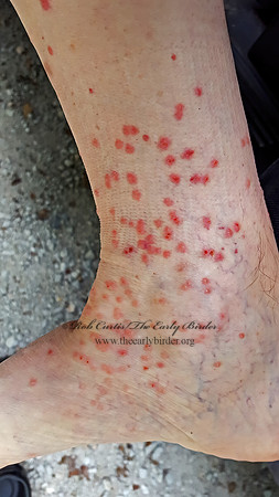 SEED TICK BITES 2000702z